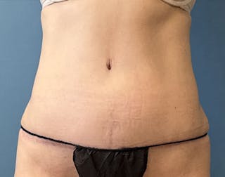 Powertuck Before & After Gallery - Patient 390821 - Image 2