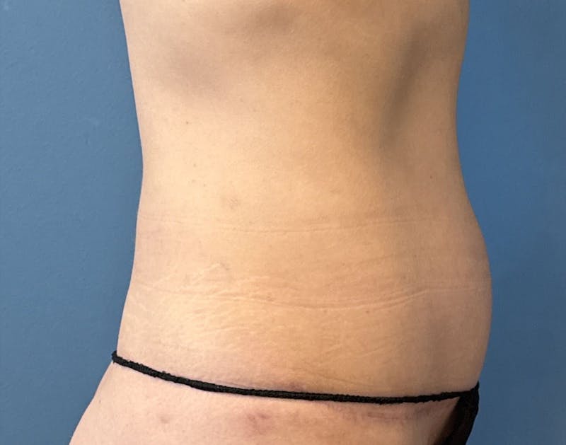 Powertuck Before & After Gallery - Patient 390821 - Image 4