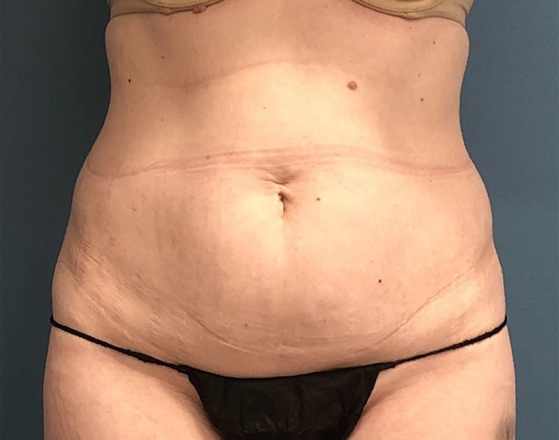 Powertuck Before & After Gallery - Patient 322392 - Image 1