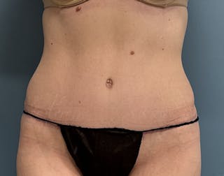 Powertuck Before & After Gallery - Patient 322392 - Image 2