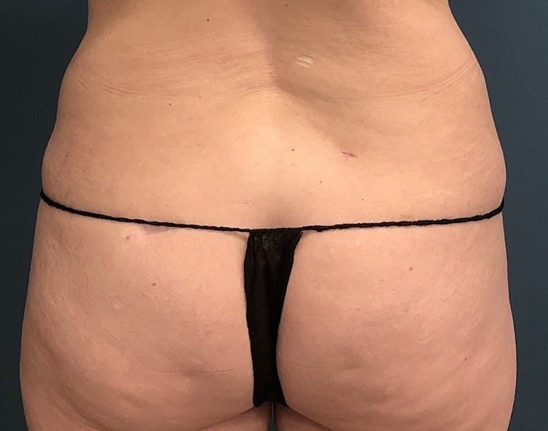 Powertuck Before & After Gallery - Patient 322392 - Image 5