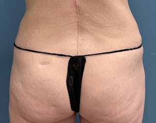 Powertuck Before & After Gallery - Patient 322392 - Image 6