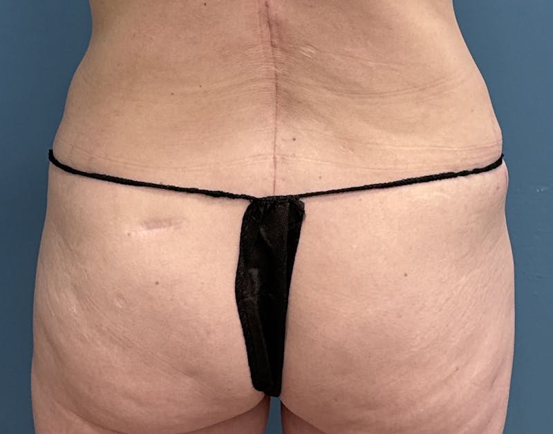 Powertuck Before & After Gallery - Patient 322392 - Image 6