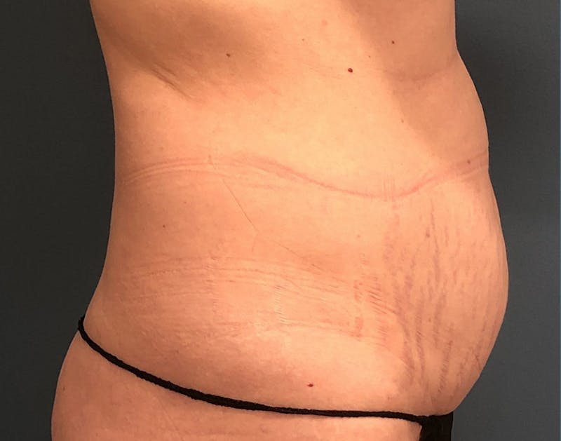 Powertuck Before & After Gallery - Patient 322392 - Image 3