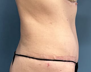 Powertuck Before & After Gallery - Patient 322392 - Image 4