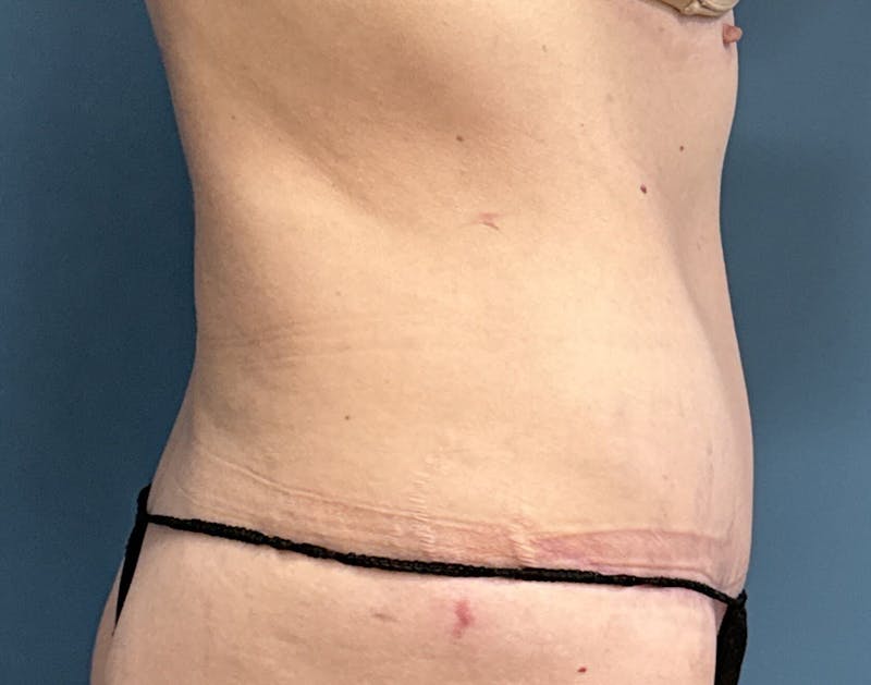 Powertuck Before & After Gallery - Patient 322392 - Image 4