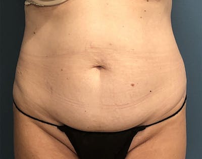 Powertuck Before & After Gallery - Patient 352452 - Image 1