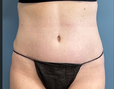Powertuck Before & After Gallery - Patient 352452 - Image 2