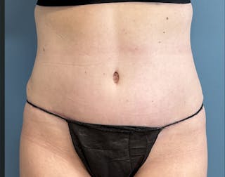 Powertuck Before & After Gallery - Patient 352452 - Image 2