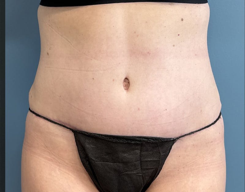Powertuck Before & After Gallery - Patient 352452 - Image 2