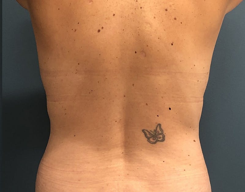 Powertuck Before & After Gallery - Patient 352452 - Image 5