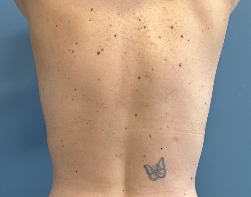 Powertuck Before & After Gallery - Patient 352452 - Image 6