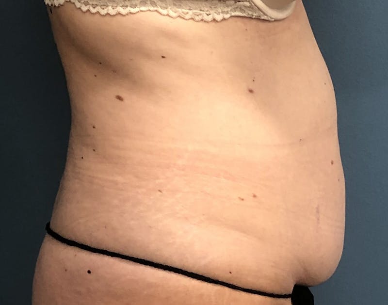 Powertuck Before & After Gallery - Patient 352452 - Image 3