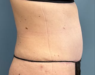 Powertuck Before & After Gallery - Patient 352452 - Image 4