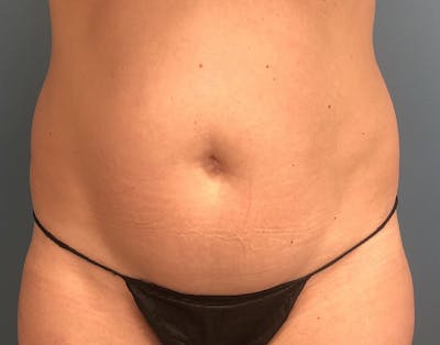 Powertuck Before & After Gallery - Patient 197204 - Image 1
