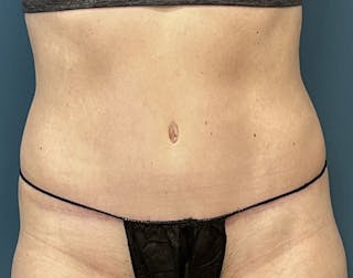 Powertuck Before & After Gallery - Patient 197204 - Image 2