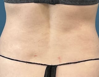 Powertuck Before & After Gallery - Patient 197204 - Image 6