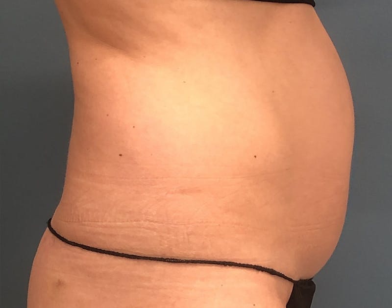 Powertuck Before & After Gallery - Patient 197204 - Image 3