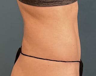 Powertuck Before & After Gallery - Patient 197204 - Image 4