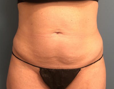 Powertuck Before & After Gallery - Patient 340410 - Image 1