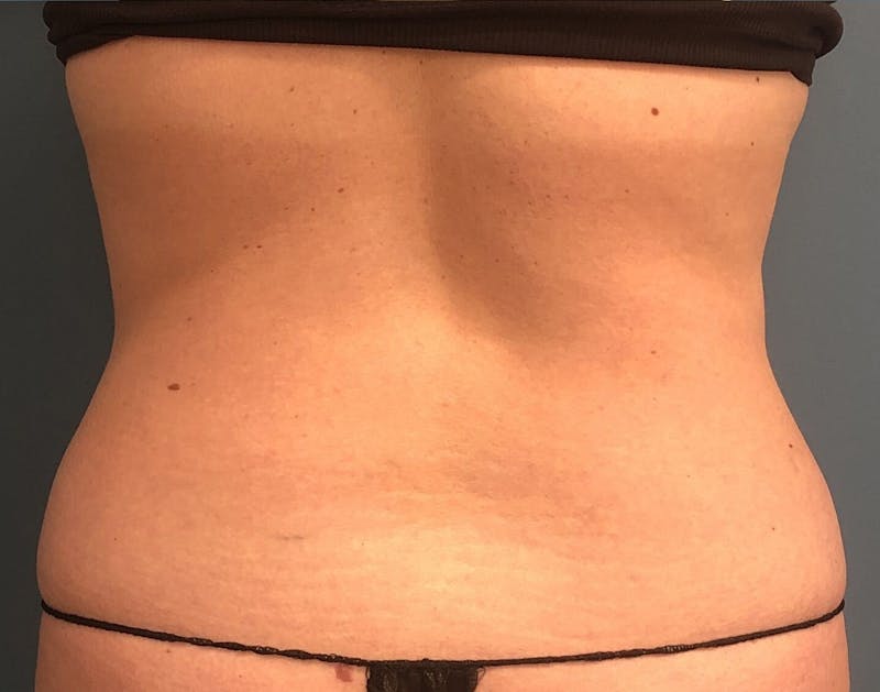 Powertuck Before & After Gallery - Patient 340410 - Image 5