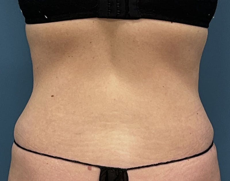 Powertuck Before & After Gallery - Patient 340410 - Image 6