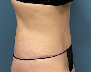 Powertuck Before & After Gallery - Patient 340410 - Image 4