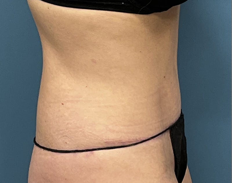 Powertuck Before & After Gallery - Patient 340410 - Image 4