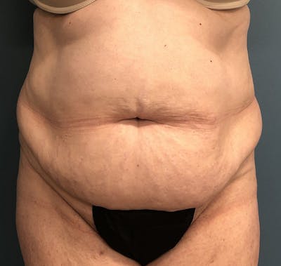 Powertuck Before & After Gallery - Patient 386001 - Image 1