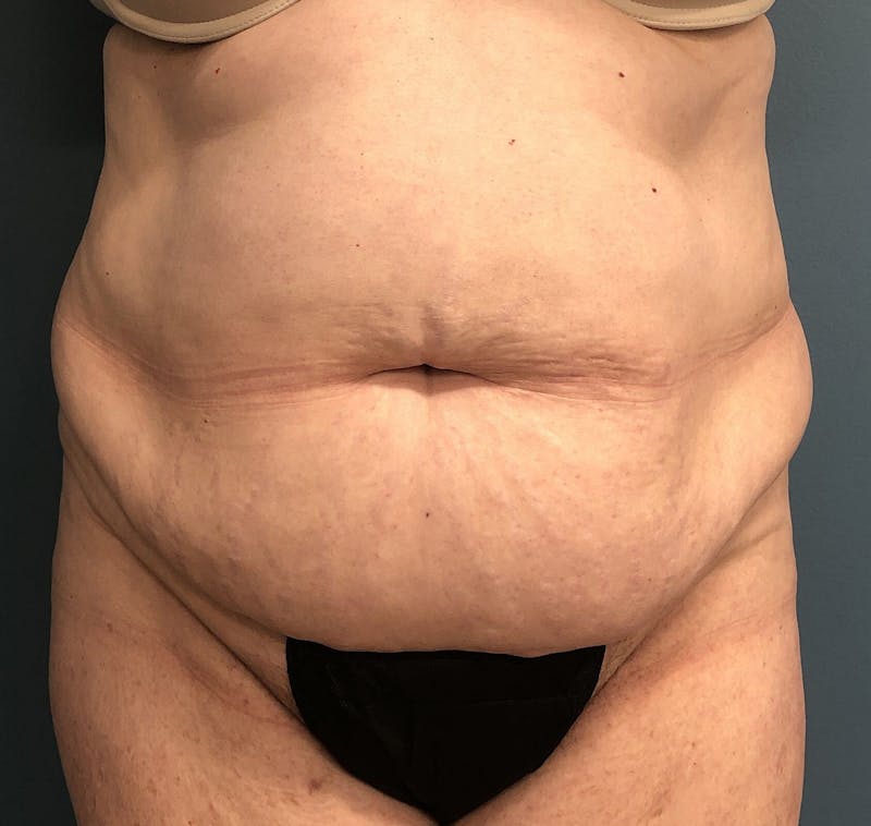 Powertuck Before & After Gallery - Patient 386001 - Image 1