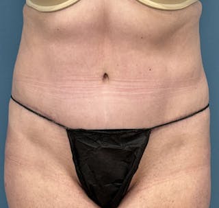 Powertuck Before & After Gallery - Patient 386001 - Image 2