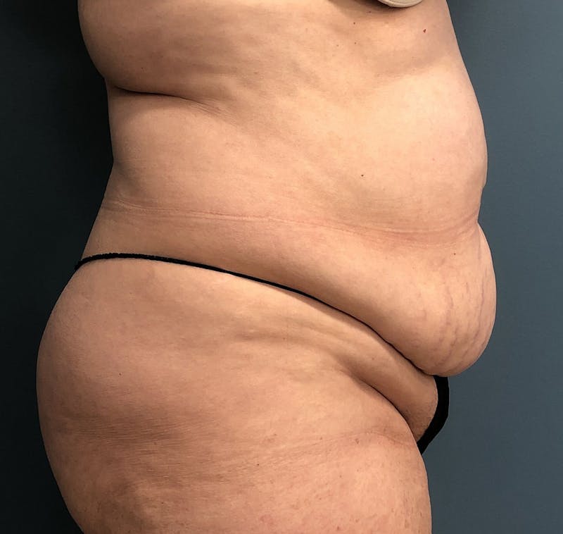 Powertuck Before & After Gallery - Patient 386001 - Image 3