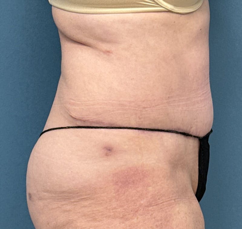 Powertuck Before & After Gallery - Patient 386001 - Image 4