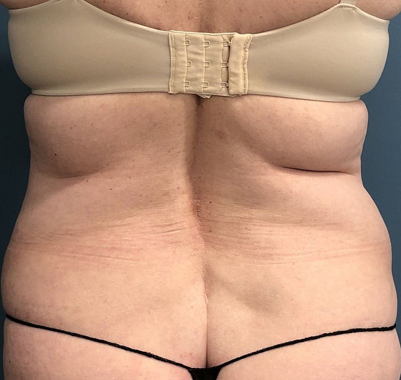 Powertuck Before & After Gallery - Patient 386001 - Image 5