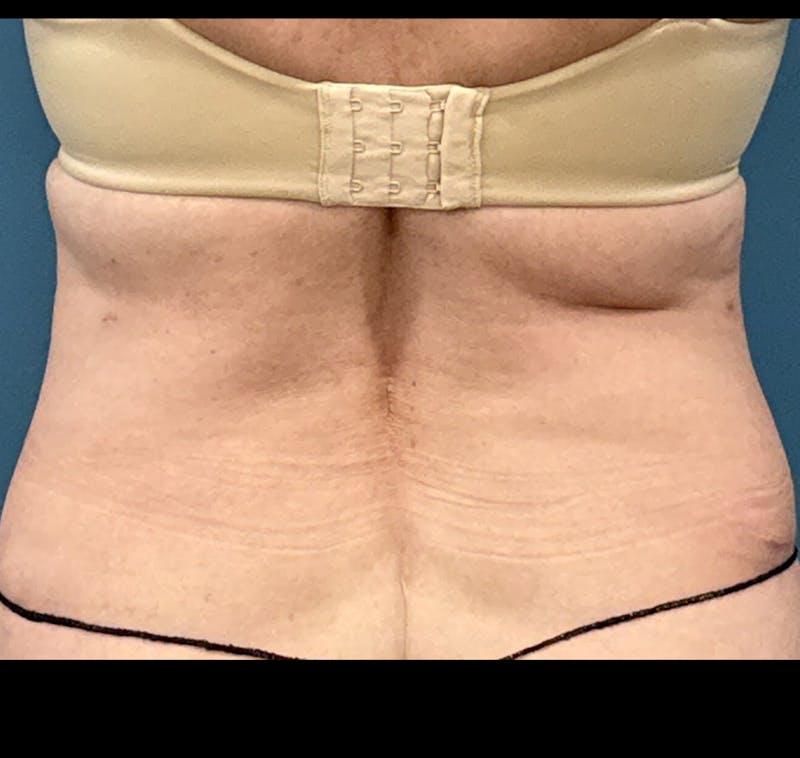 Powertuck Before & After Gallery - Patient 386001 - Image 6