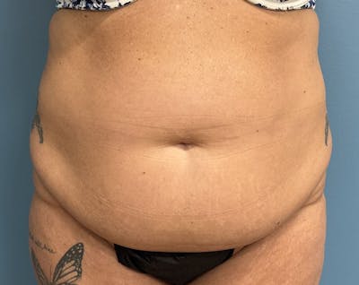 Powertuck Before & After Gallery - Patient 204982 - Image 1