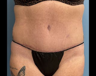 Powertuck Before & After Gallery - Patient 204982 - Image 2