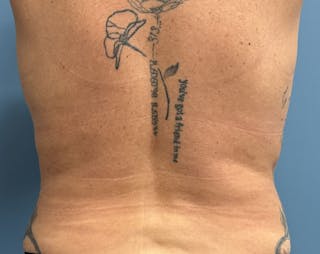 Powertuck Before & After Gallery - Patient 204982 - Image 6