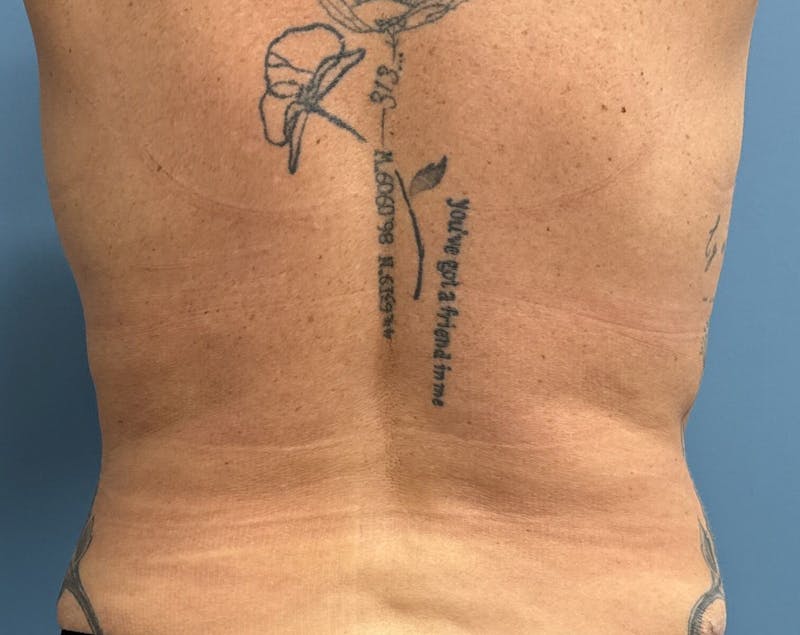 Powertuck Before & After Gallery - Patient 204982 - Image 6