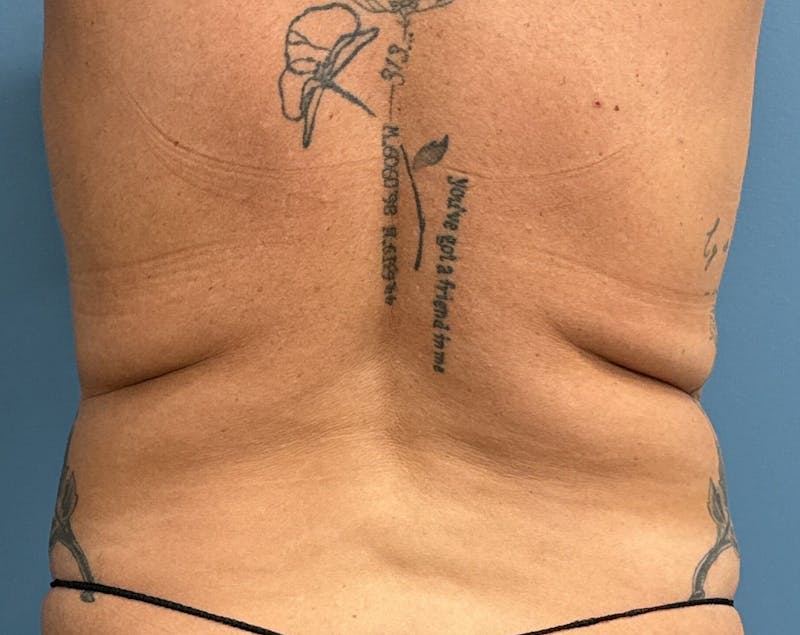 Powertuck Before & After Gallery - Patient 204982 - Image 5