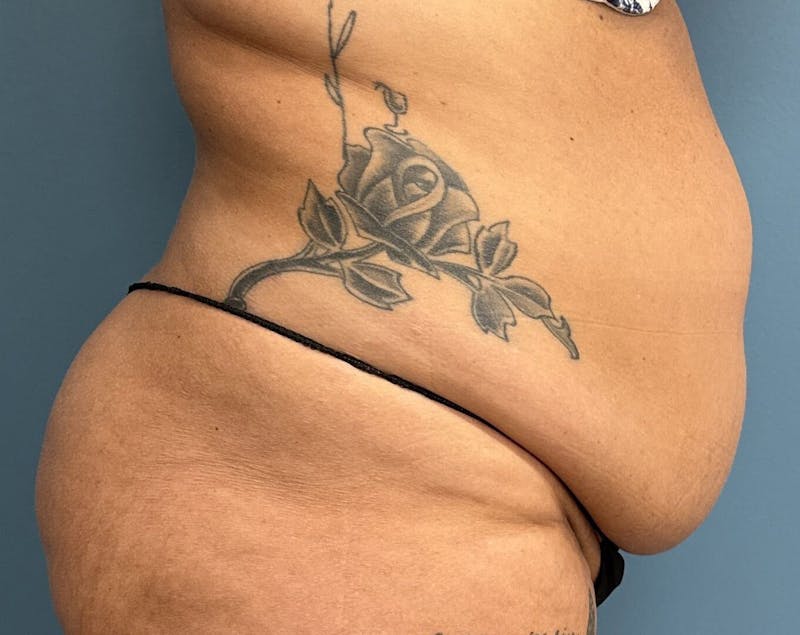 Powertuck Before & After Gallery - Patient 204982 - Image 3