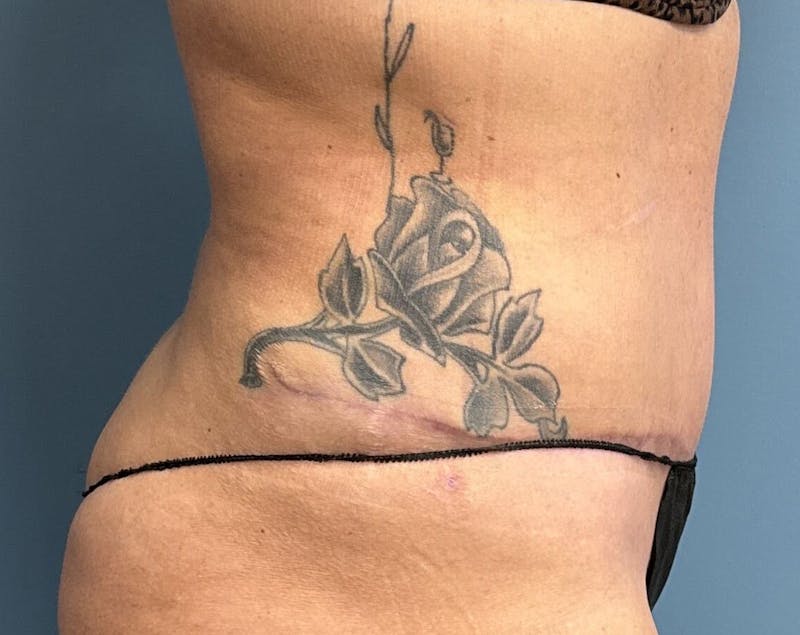 Powertuck Before & After Gallery - Patient 204982 - Image 4