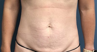 Tummy Tuck Before & After Gallery - Patient 169934 - Image 1