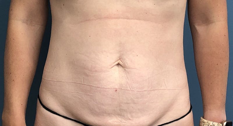Tummy Tuck Before & After Gallery - Patient 169934 - Image 1