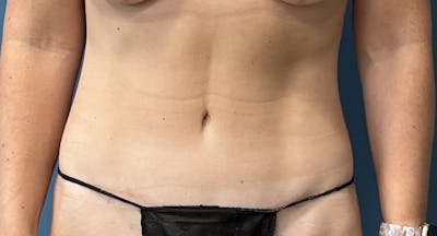 Tummy Tuck Before & After Gallery - Patient 169934 - Image 2