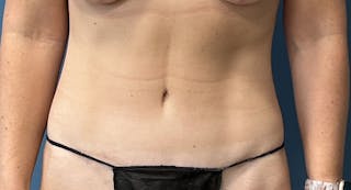 Tummy Tuck Before & After Gallery - Patient 169934 - Image 2