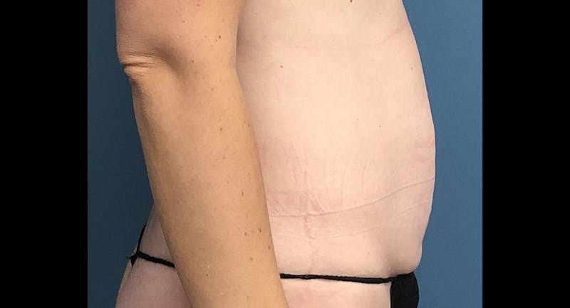 Tummy Tuck Before & After Gallery - Patient 169934 - Image 3