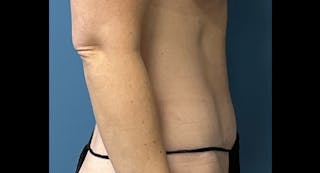 Tummy Tuck Before & After Gallery - Patient 169934 - Image 4