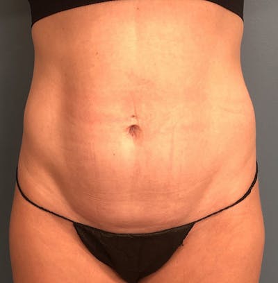 Tummy Tuck Before & After Gallery - Patient 336228 - Image 1