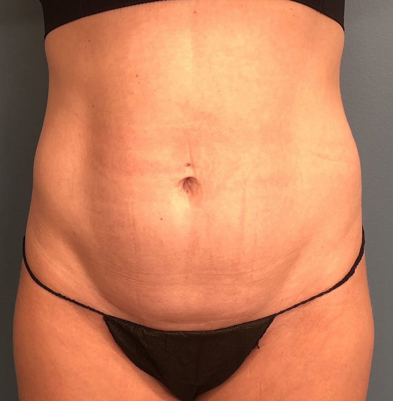 Tummy Tuck Before & After Gallery - Patient 336228 - Image 1